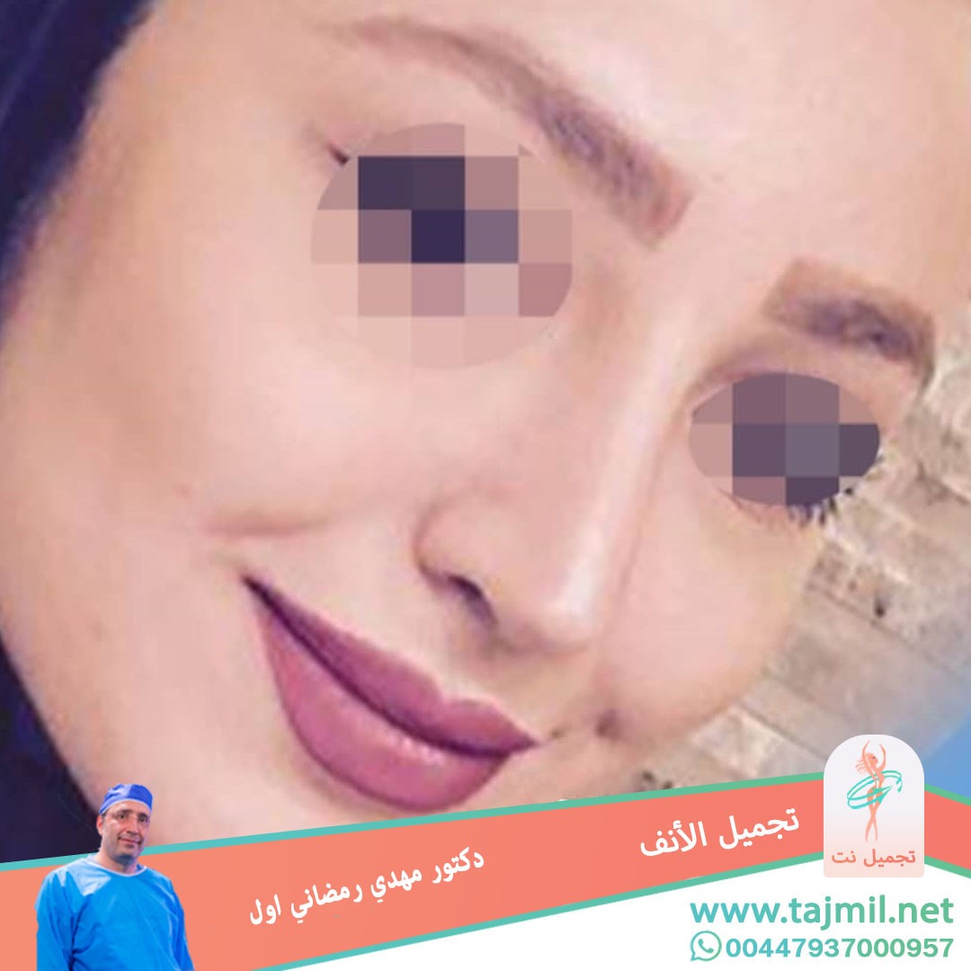  - دكتور مهدي رمضاني اول عملية تجميل الانف في ايران مع تجميل نت