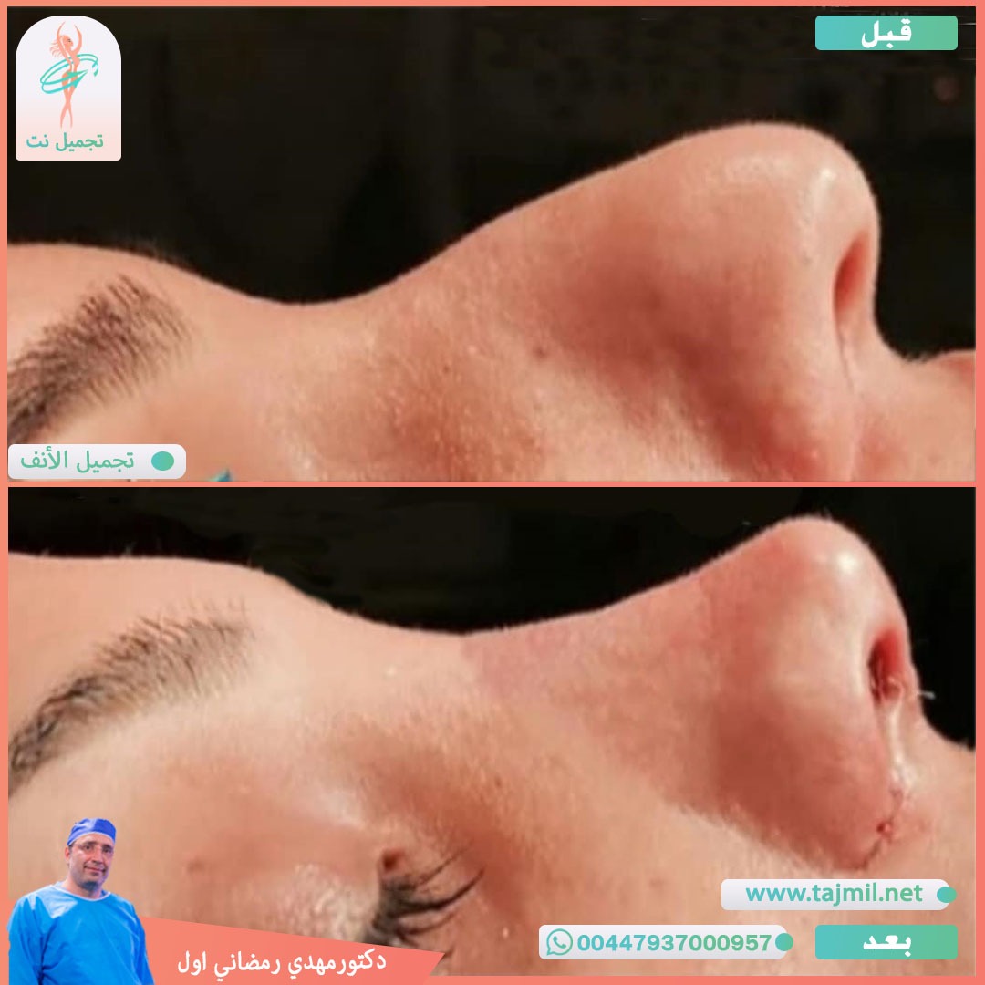  - دكتور مهدي رمضاني اول عملية تجميل الانف في ايران مع تجميل نت