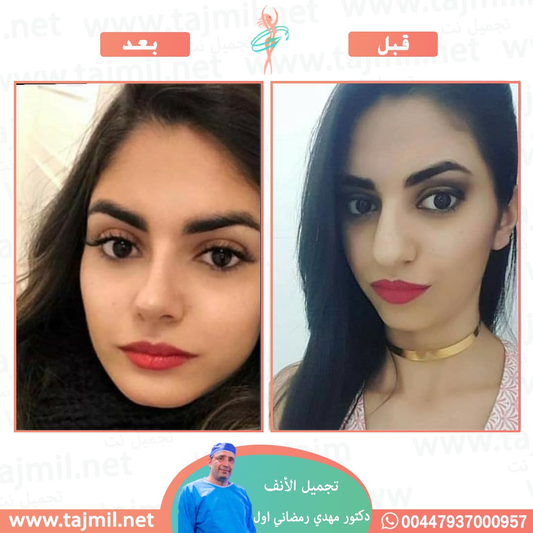  - دكتور مهدي رمضاني اول عملية تجميل الانف في ايران مع تجميل نت