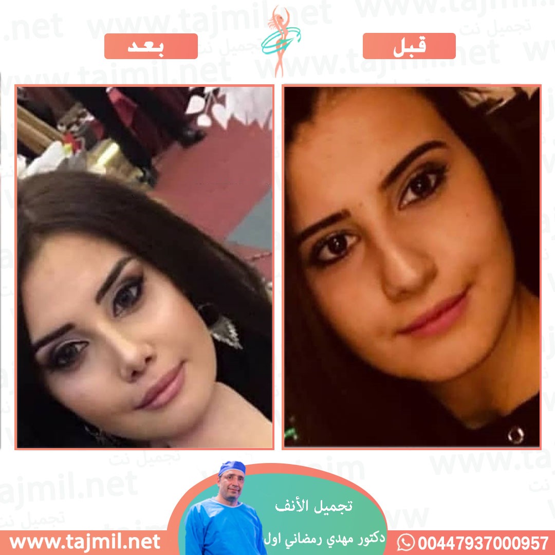  - دكتور مهدي رمضاني اول عملية تجميل الانف في ايران مع تجميل نت