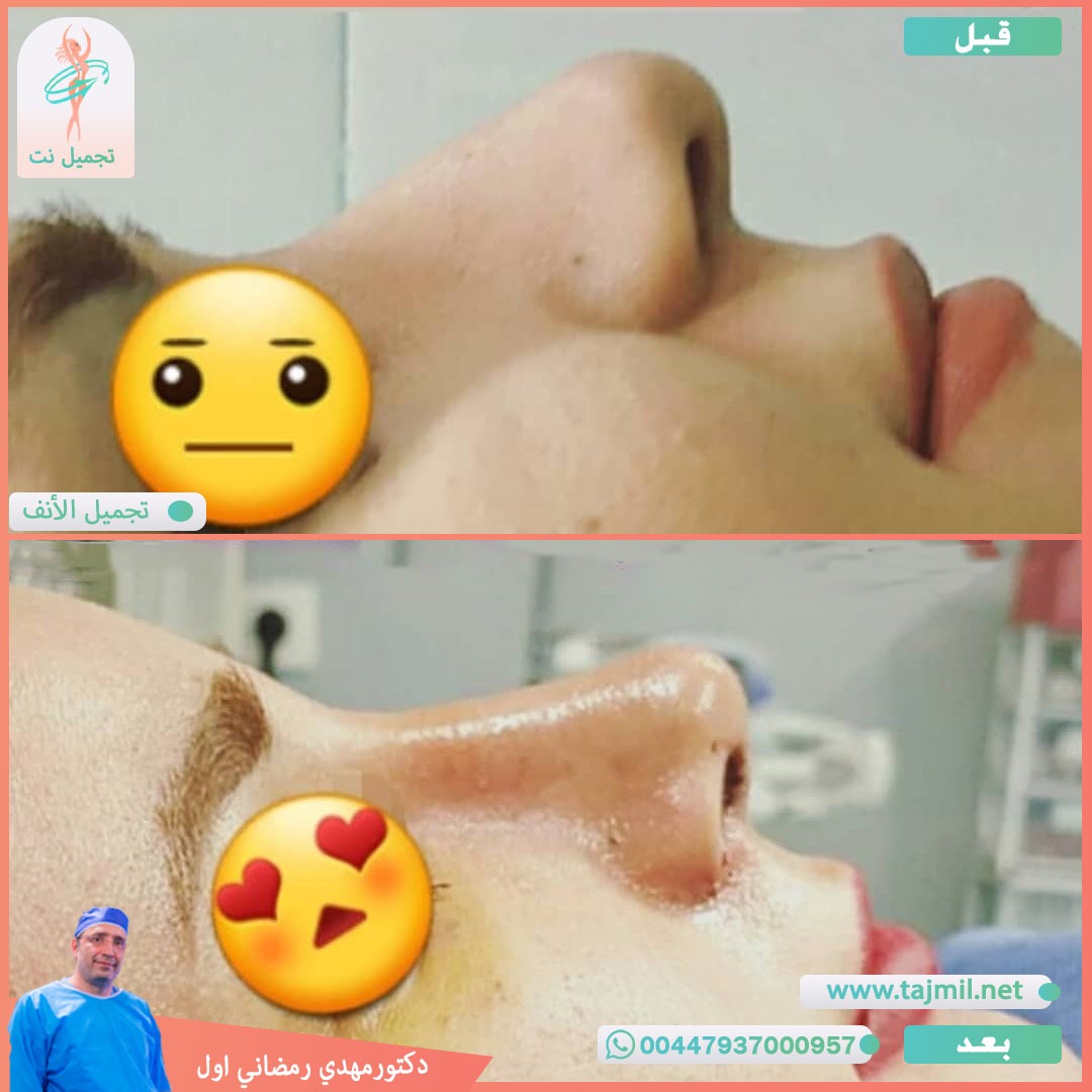  - دكتور مهدي رمضاني اول عملية تجميل الانف في ايران مع تجميل نت