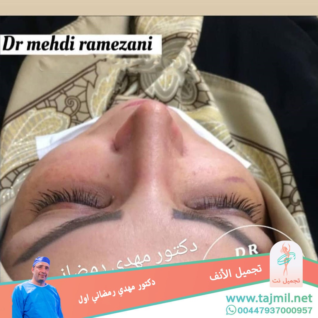  - دكتور مهدي رمضاني اول عملية تجميل الانف في ايران مع تجميل نت