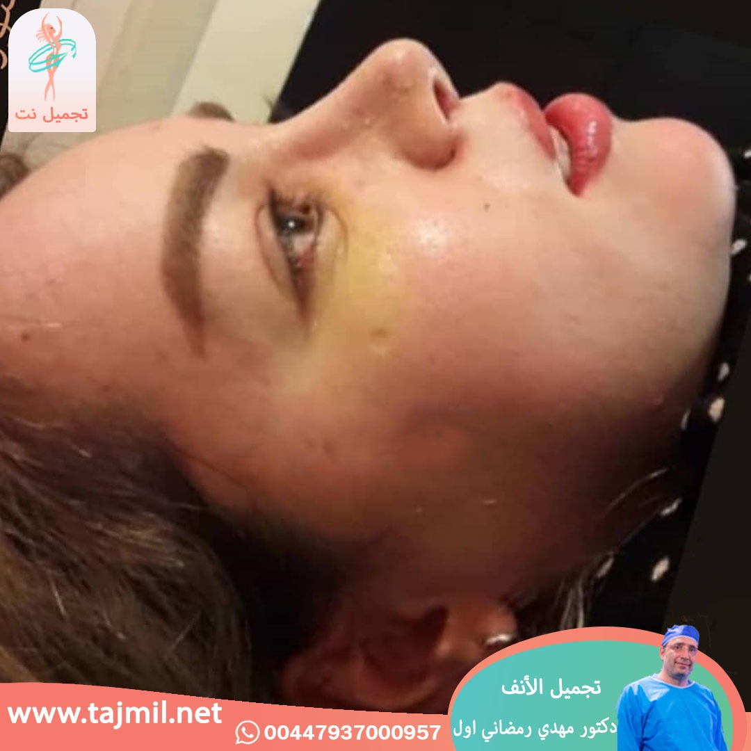  - دكتور مهدي رمضاني اول عملية تجميل الانف في ايران مع تجميل نت