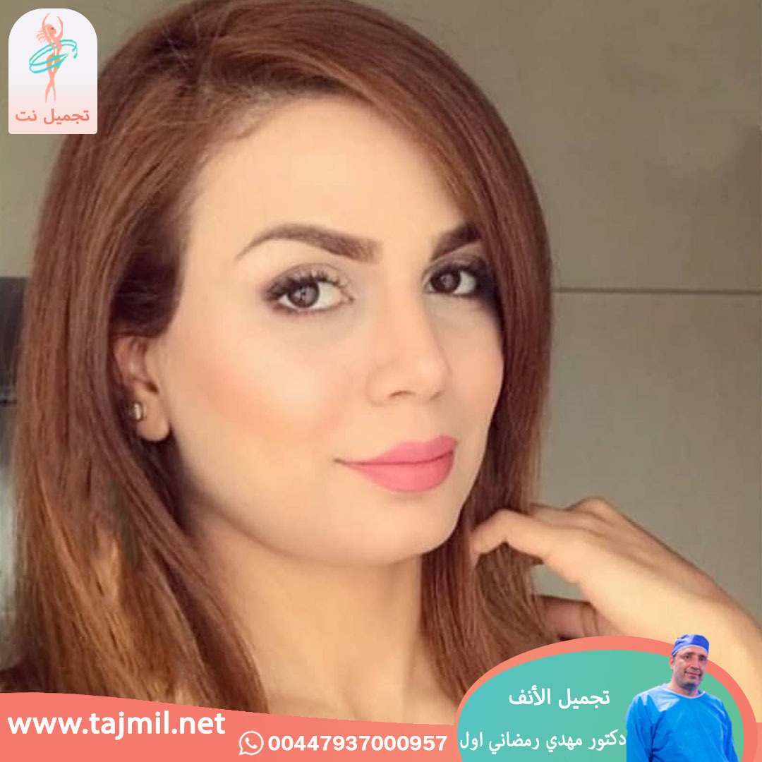  - دكتور مهدي رمضاني اول عملية تجميل الانف في ايران مع تجميل نت