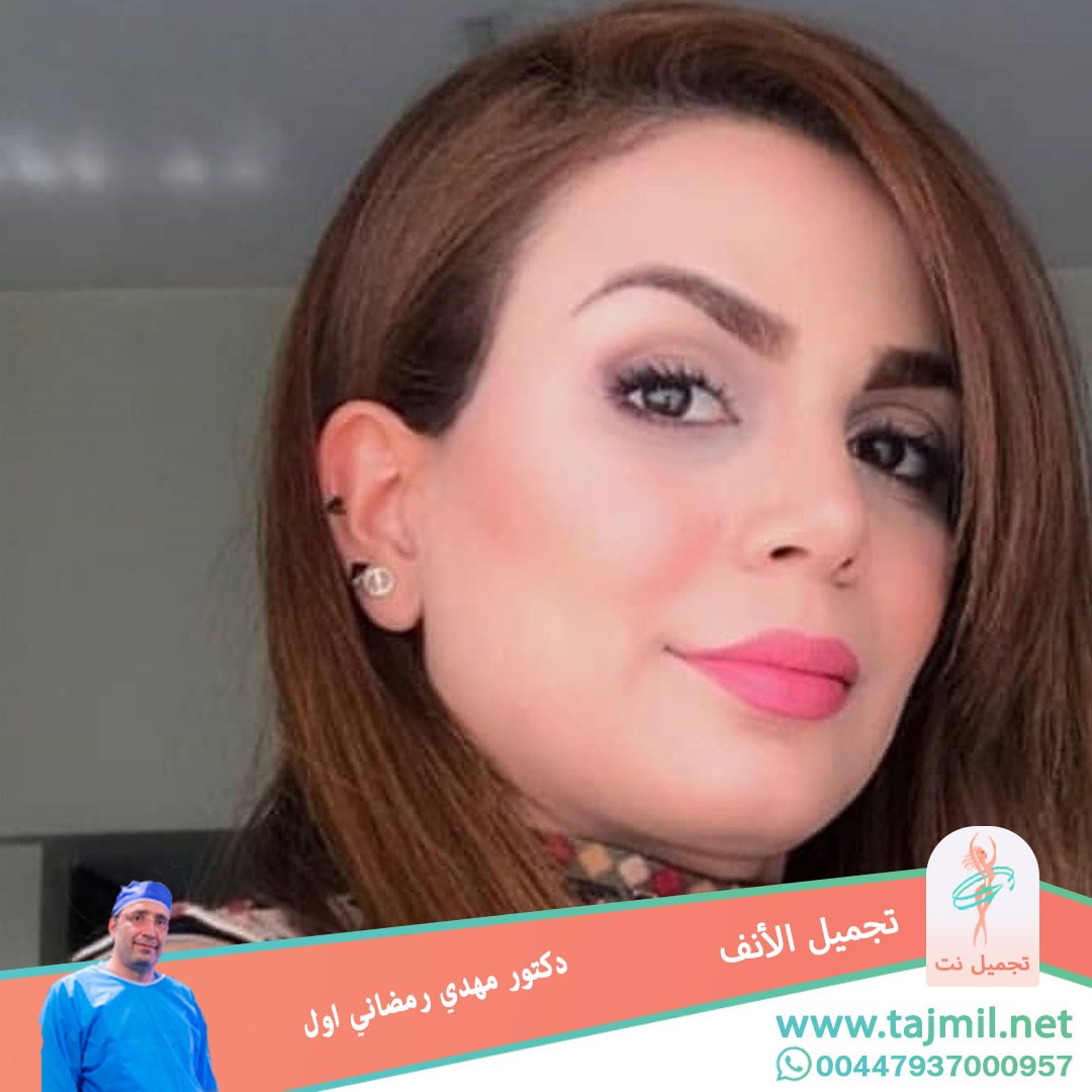  - دكتور مهدي رمضاني اول عملية تجميل الانف في ايران مع تجميل نت