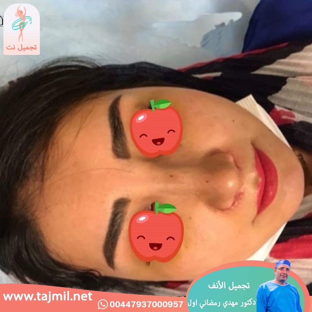  - دكتور مهدي رمضاني اول عملية تجميل الانف في ايران مع تجميل نت