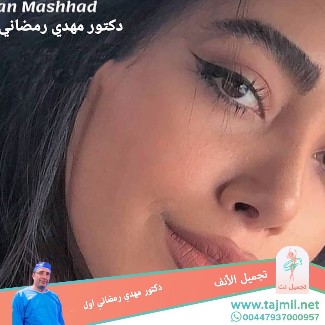  - دكتور مهدي رمضاني اول عملية تجميل الانف في ايران مع تجميل نت