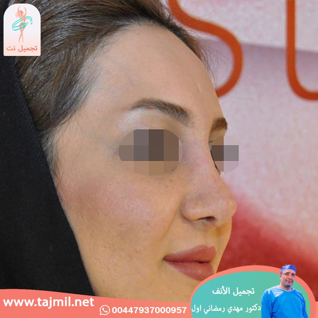  - دكتور مهدي رمضاني اول عملية تجميل الانف في ايران مع تجميل نت