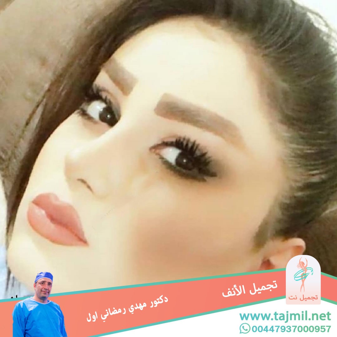  - دكتور مهدي رمضاني اول عملية تجميل الانف في ايران مع تجميل نت