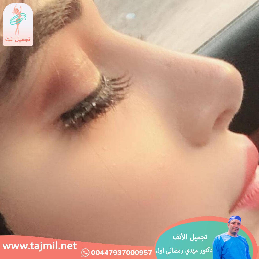  - دكتور مهدي رمضاني اول عملية تجميل الانف في ايران مع تجميل نت