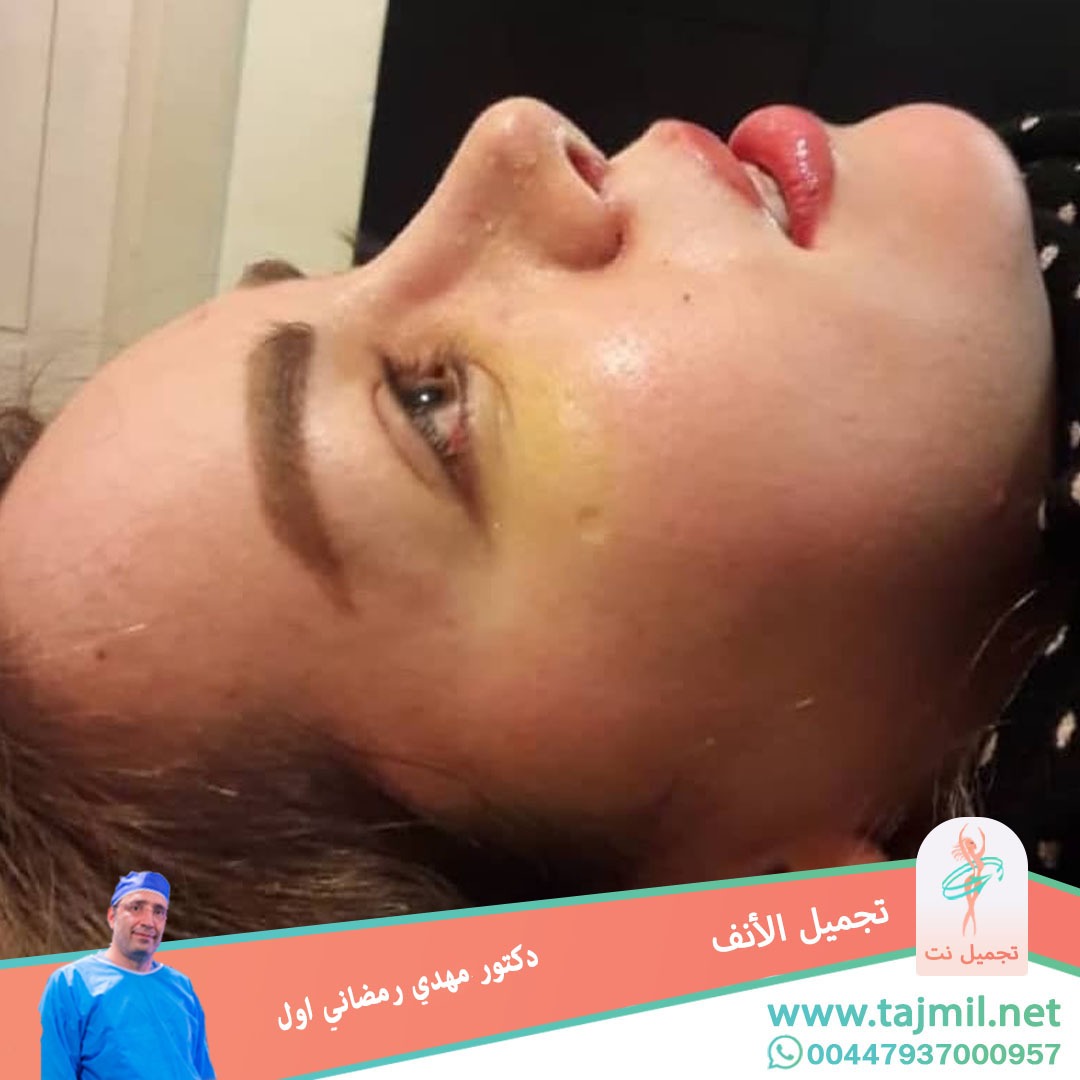  - دكتور مهدي رمضاني اول عملية تجميل الانف في ايران مع تجميل نت