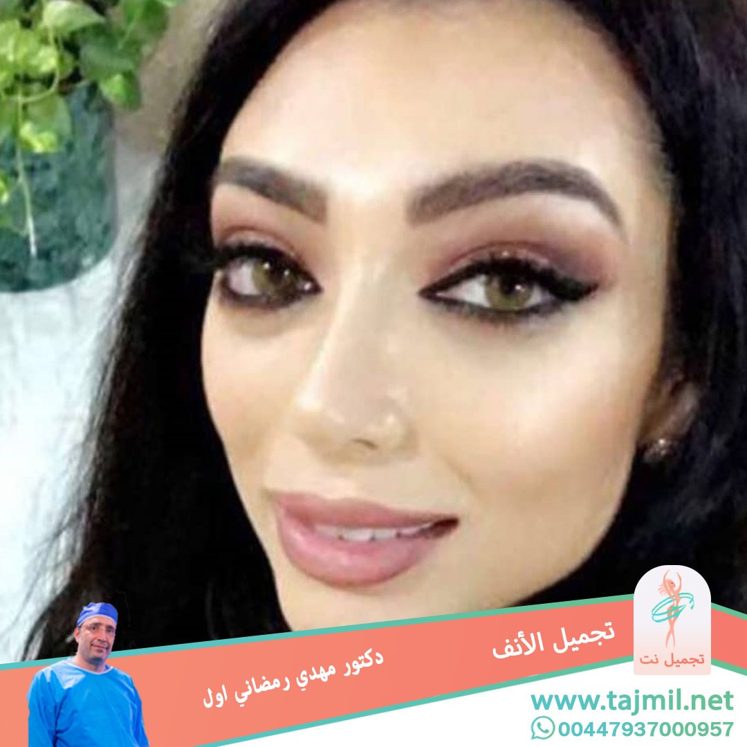  - دكتور مهدي رمضاني اول عملية تجميل الانف في ايران مع تجميل نت