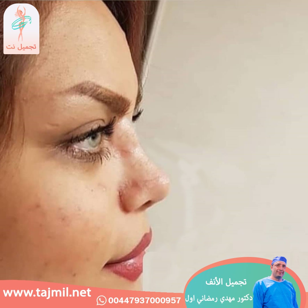  - دكتور مهدي رمضاني اول عملية تجميل الانف في ايران مع تجميل نت