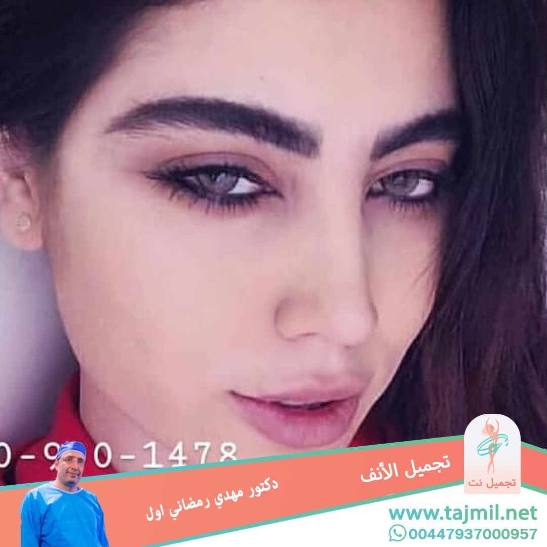  - دكتور مهدي رمضاني اول عملية تجميل الانف في ايران مع تجميل نت