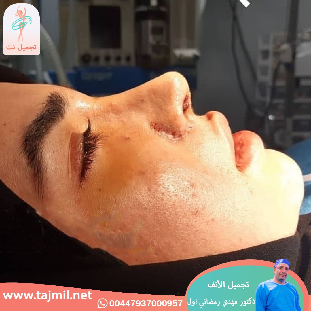  - دكتور مهدي رمضاني اول عملية تجميل الانف في ايران مع تجميل نت