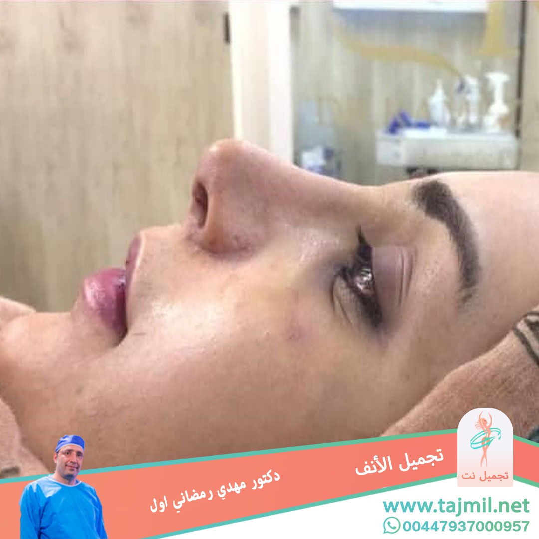  - دكتور مهدي رمضاني اول عملية تجميل الانف في ايران مع تجميل نت