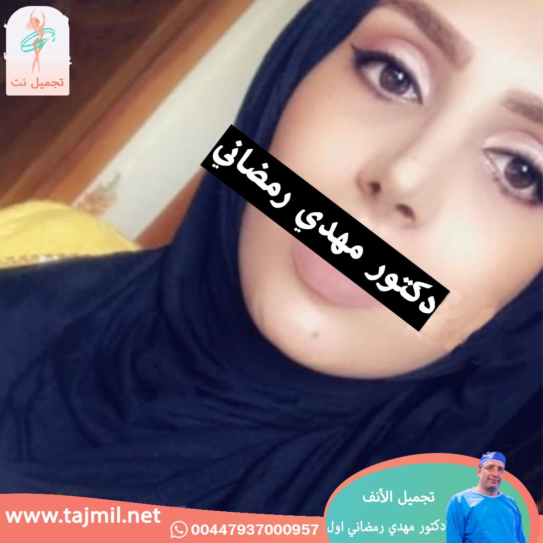  - دكتور مهدي رمضاني اول عملية تجميل الانف في ايران مع تجميل نت