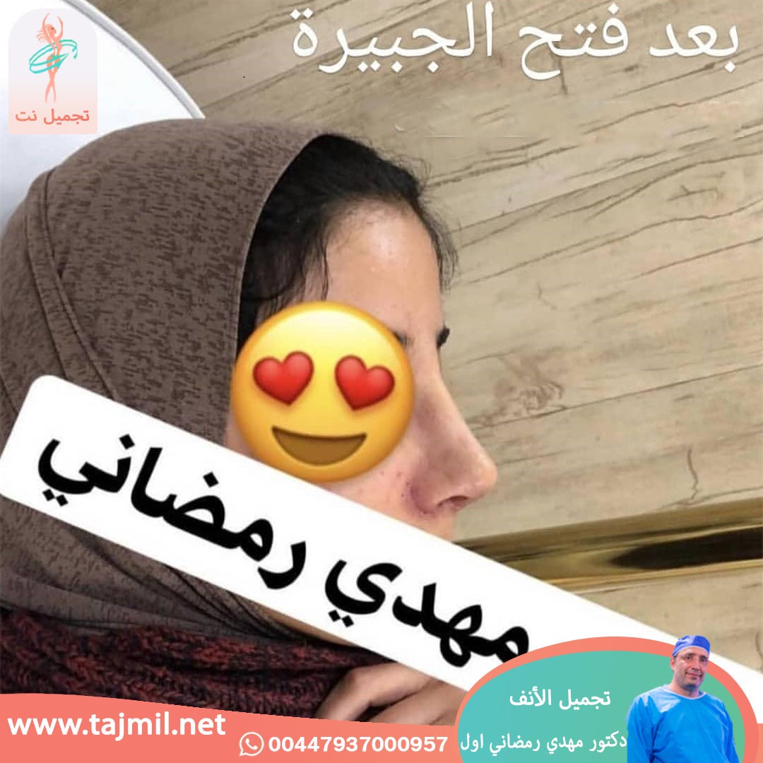  - دكتور مهدي رمضاني اول عملية تجميل الانف في ايران مع تجميل نت