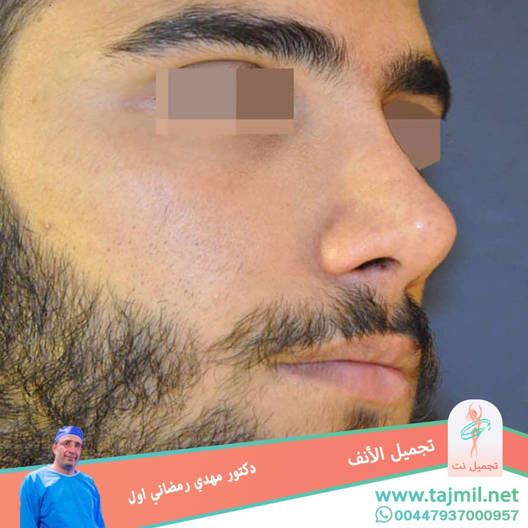  - دكتور مهدي رمضاني اول عملية تجميل الانف في ايران مع تجميل نت