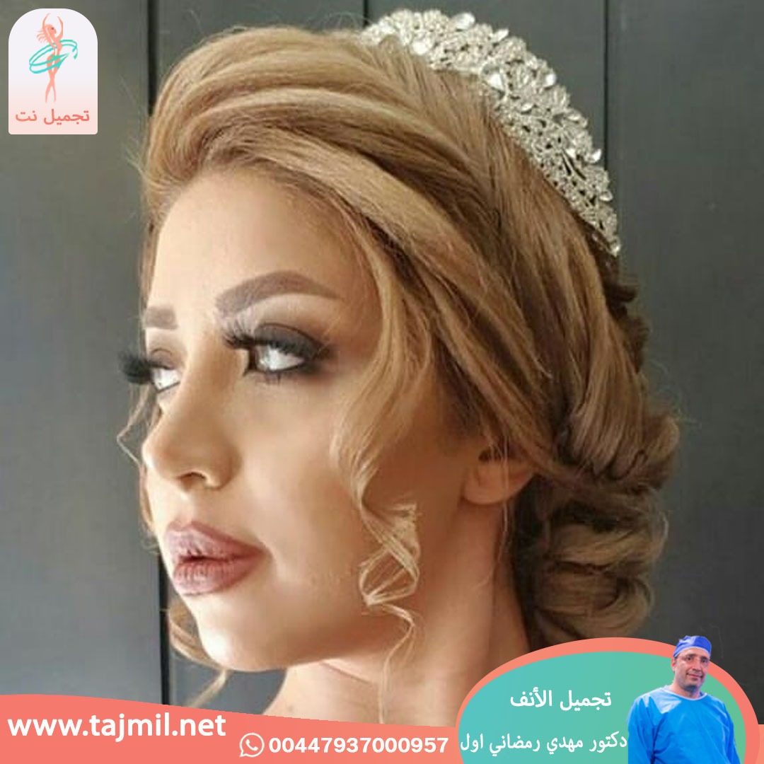  - دكتور مهدي رمضاني اول عملية تجميل الانف في ايران مع تجميل نت