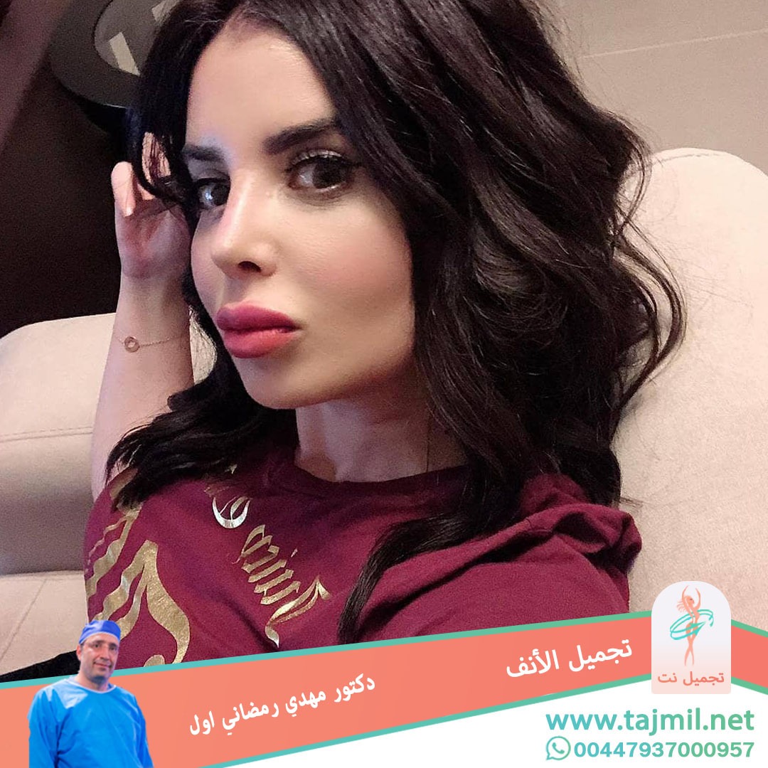  - دكتور مهدي رمضاني اول عملية تجميل الانف في ايران مع تجميل نت