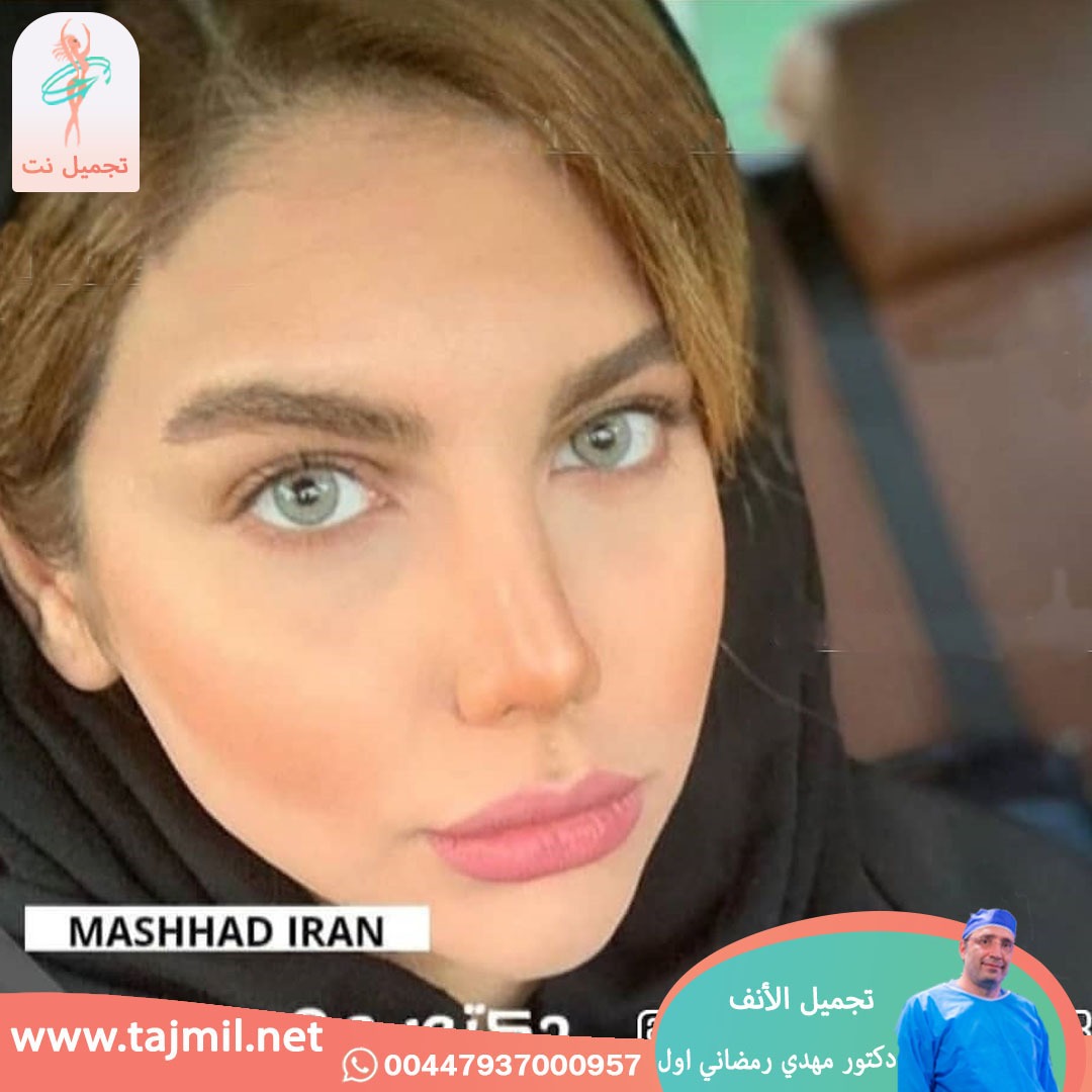  - دكتور مهدي رمضاني اول عملية تجميل الانف في ايران مع تجميل نت