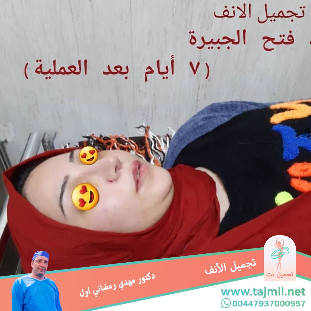  - دكتور مهدي رمضاني اول عملية تجميل الانف في ايران مع تجميل نت