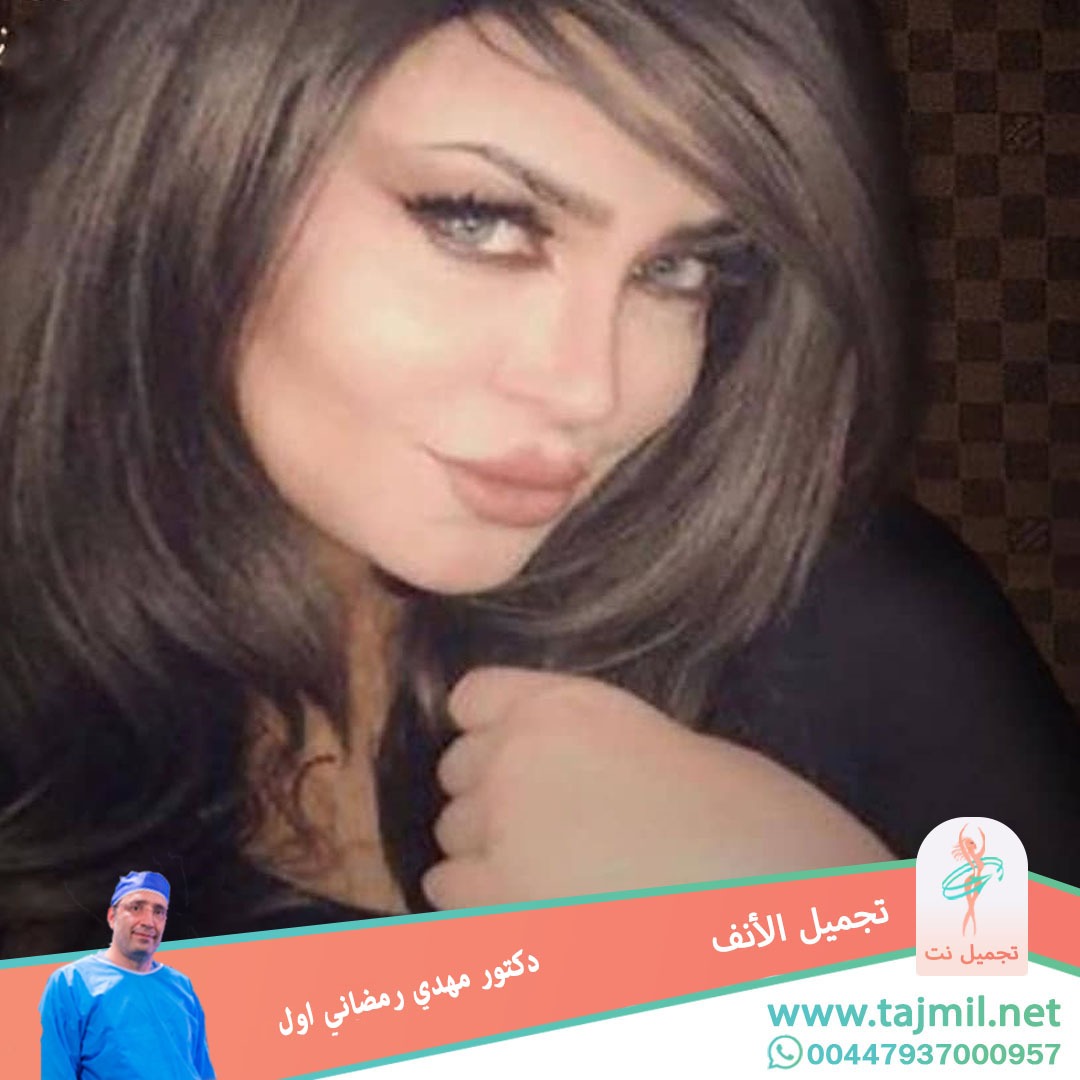  - دكتور مهدي رمضاني اول عملية تجميل الانف في ايران مع تجميل نت