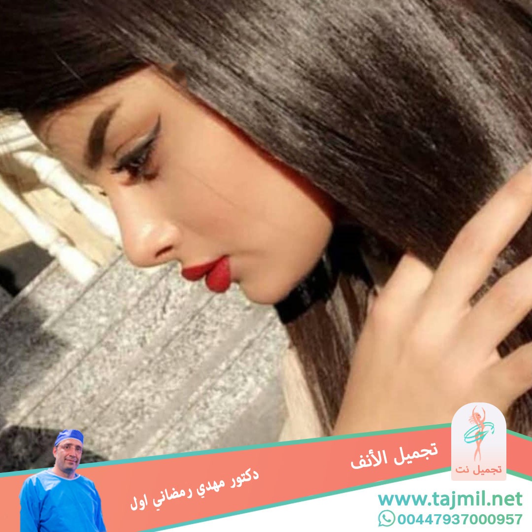  - دكتور مهدي رمضاني اول عملية تجميل الانف في ايران مع تجميل نت