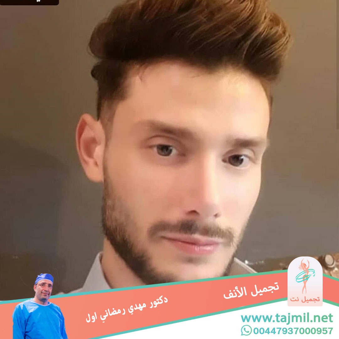  - دكتور مهدي رمضاني اول عملية تجميل الانف في ايران مع تجميل نت