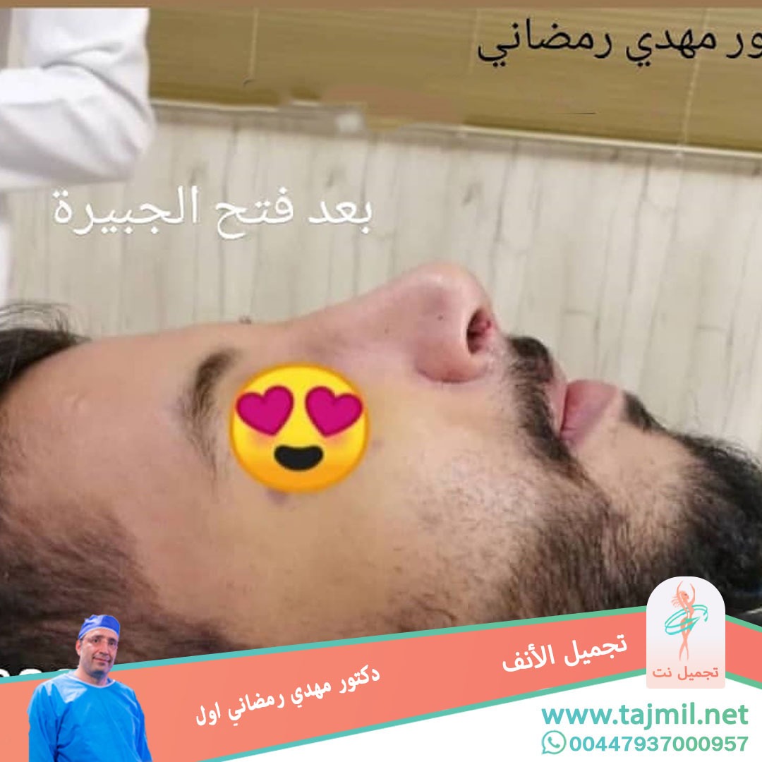  - دكتور مهدي رمضاني اول عملية تجميل الانف في ايران مع تجميل نت