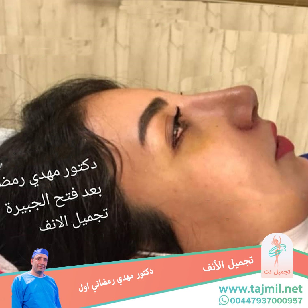  - دكتور مهدي رمضاني اول عملية تجميل الانف في ايران مع تجميل نت