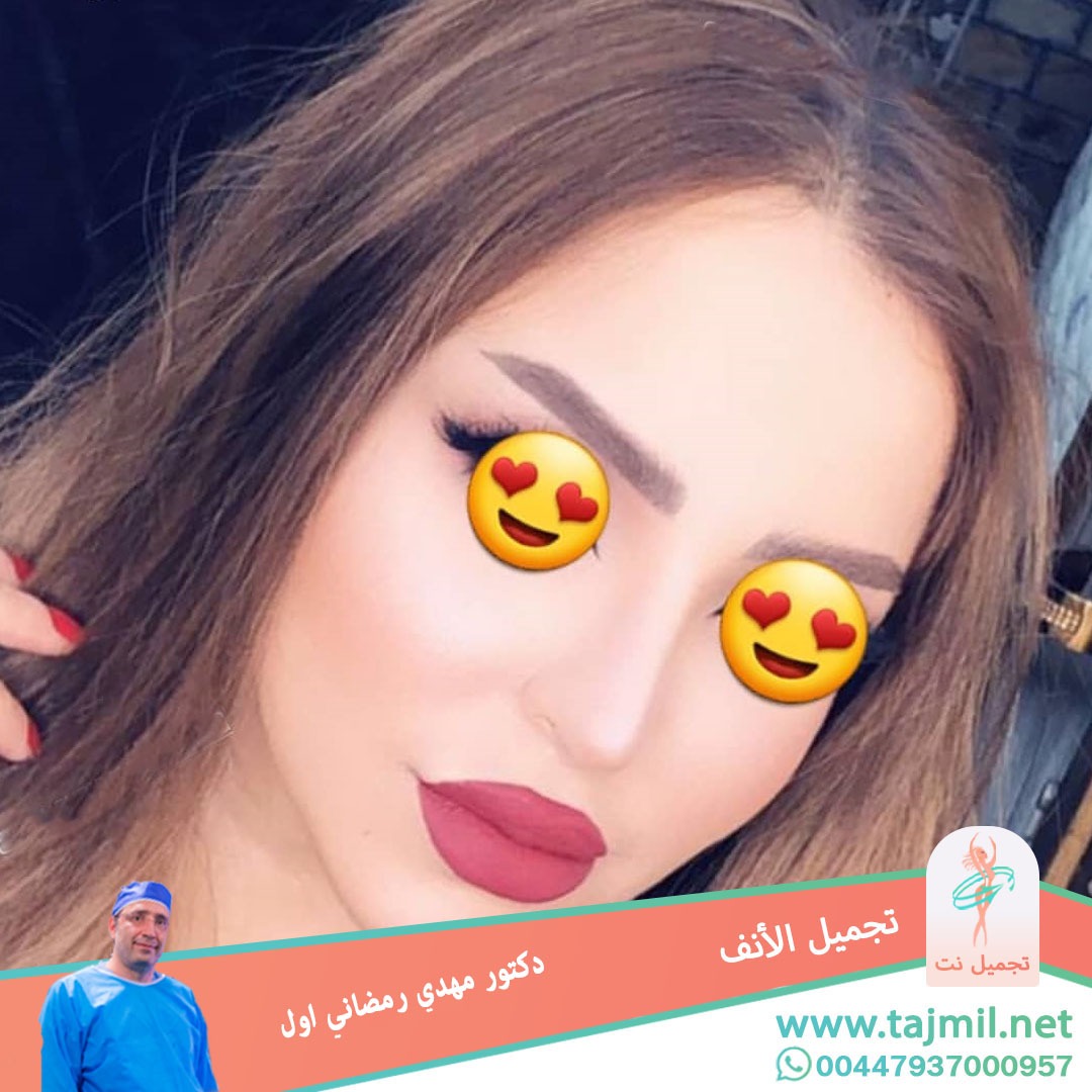  - دكتور مهدي رمضاني اول عملية تجميل الانف في ايران مع تجميل نت