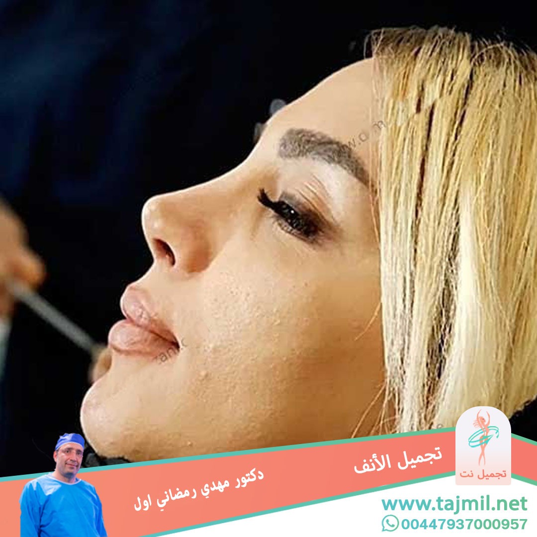  - دكتور مهدي رمضاني اول عملية تجميل الانف في ايران مع تجميل نت