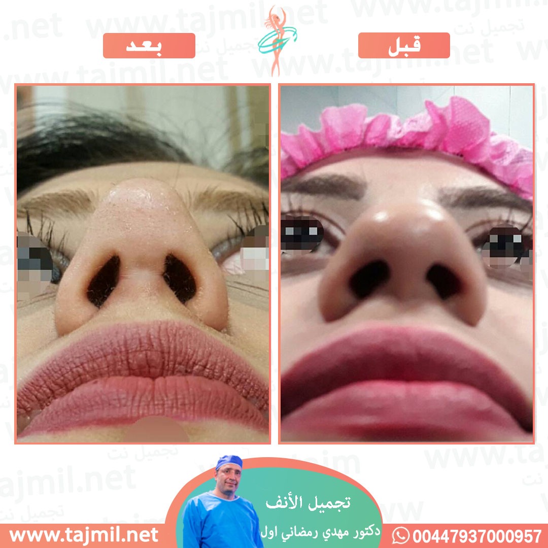  - دكتور مهدي رمضاني اول عملية تجميل الانف في ايران مع تجميل نت