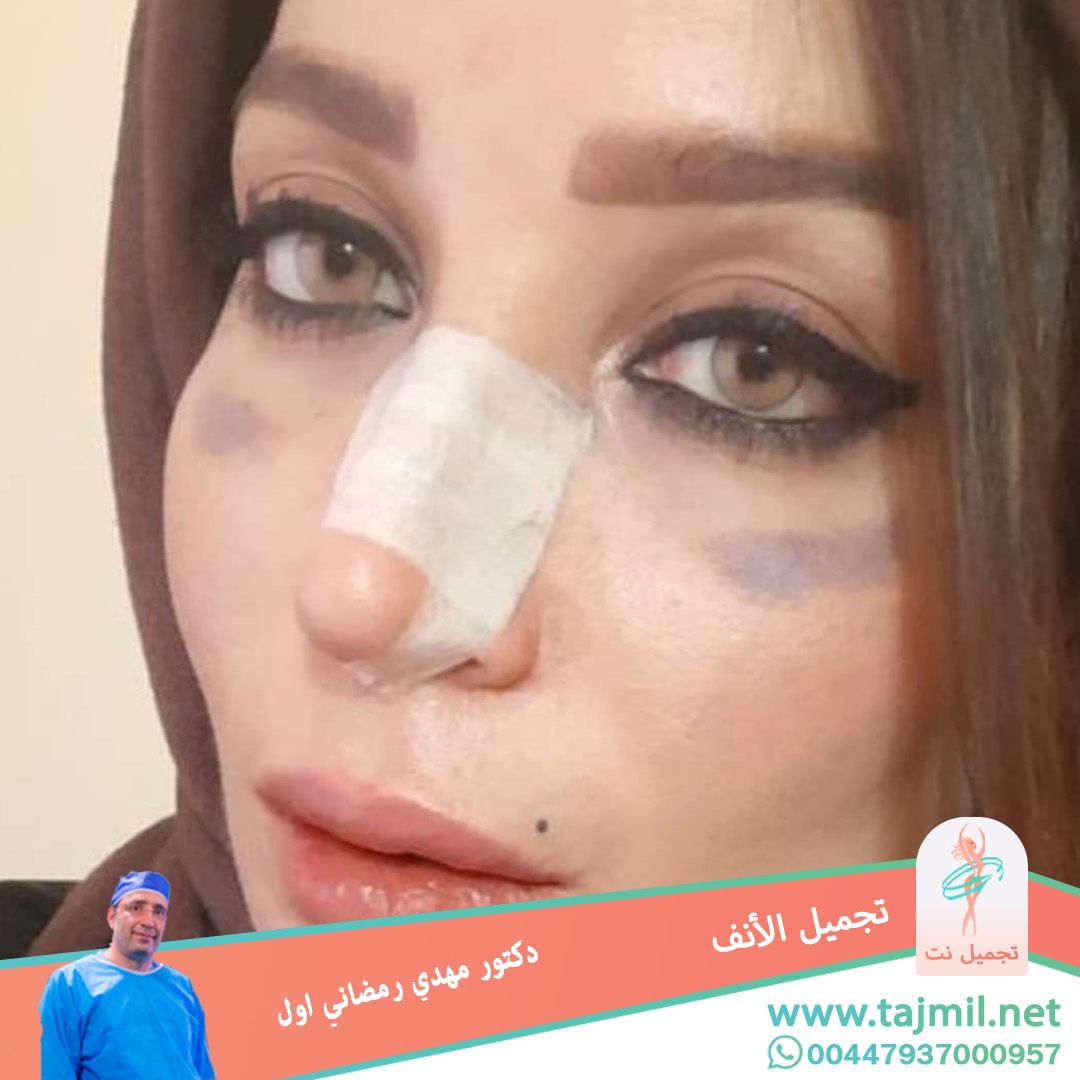  - دكتور مهدي رمضاني اول عملية تجميل الانف في ايران مع تجميل نت