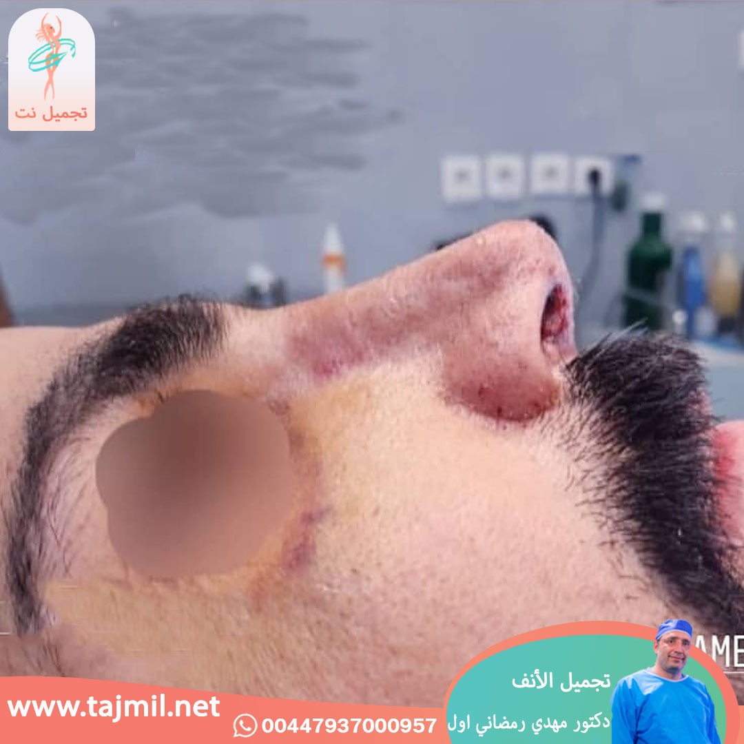  - دكتور مهدي رمضاني اول عملية تجميل الانف في ايران مع تجميل نت