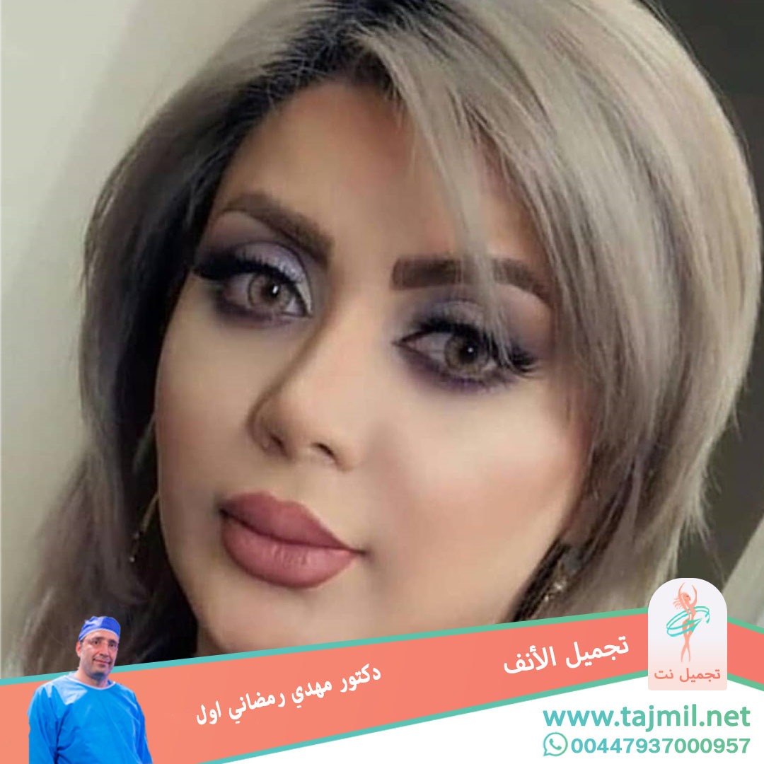  - دكتور مهدي رمضاني اول عملية تجميل الانف في ايران مع تجميل نت