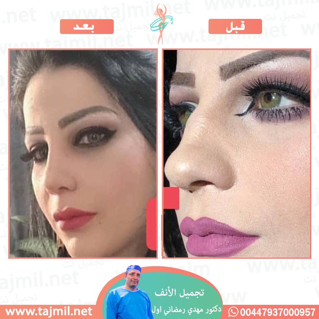  - دكتور مهدي رمضاني اول عملية تجميل الانف في ايران مع تجميل نت