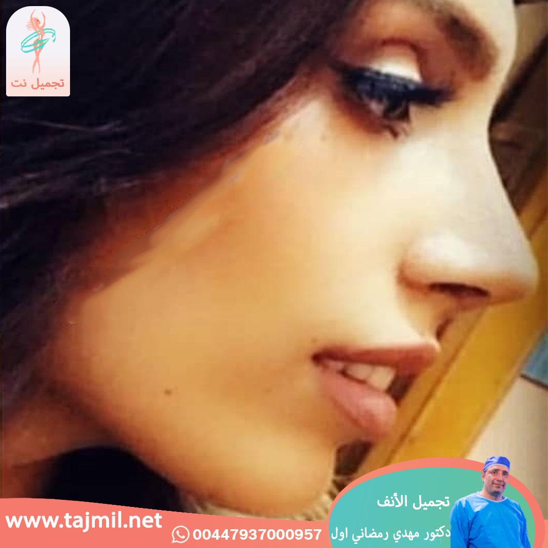  - دكتور مهدي رمضاني اول عملية تجميل الانف في ايران مع تجميل نت