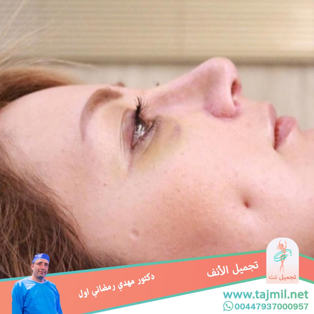  - دكتور مهدي رمضاني اول عملية تجميل الانف في ايران مع تجميل نت