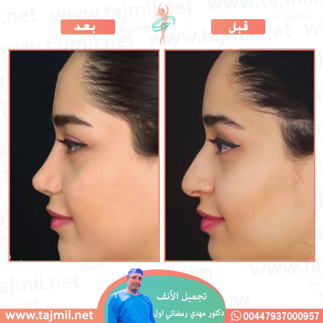  - دكتور مهدي رمضاني اول عملية تجميل الانف في ايران مع تجميل نت