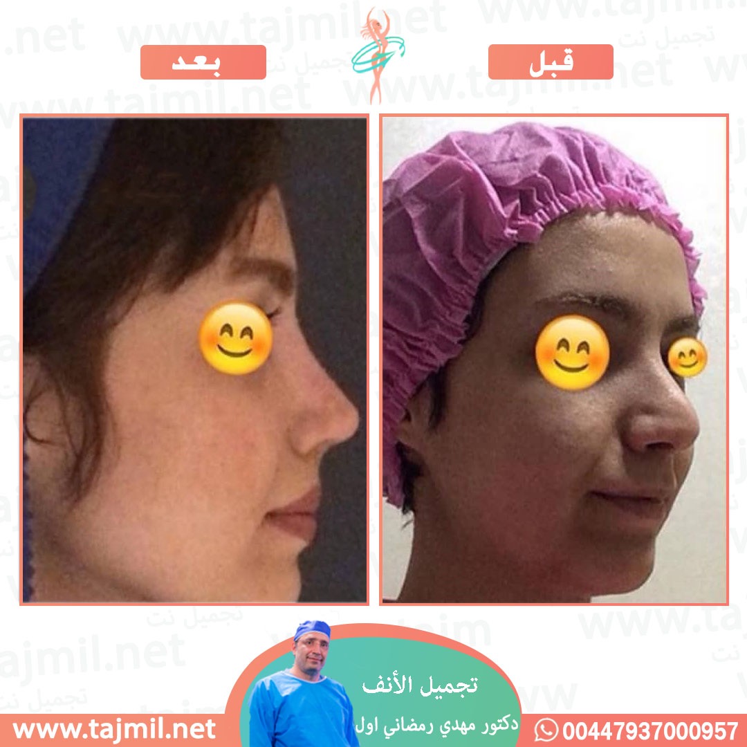  - دكتور مهدي رمضاني اول عملية تجميل الانف في ايران مع تجميل نت