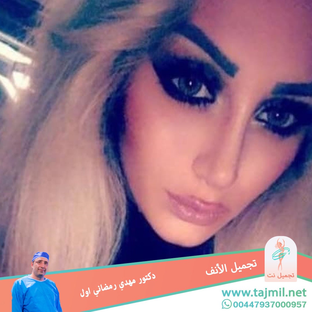  - دكتور مهدي رمضاني اول عملية تجميل الانف في ايران مع تجميل نت