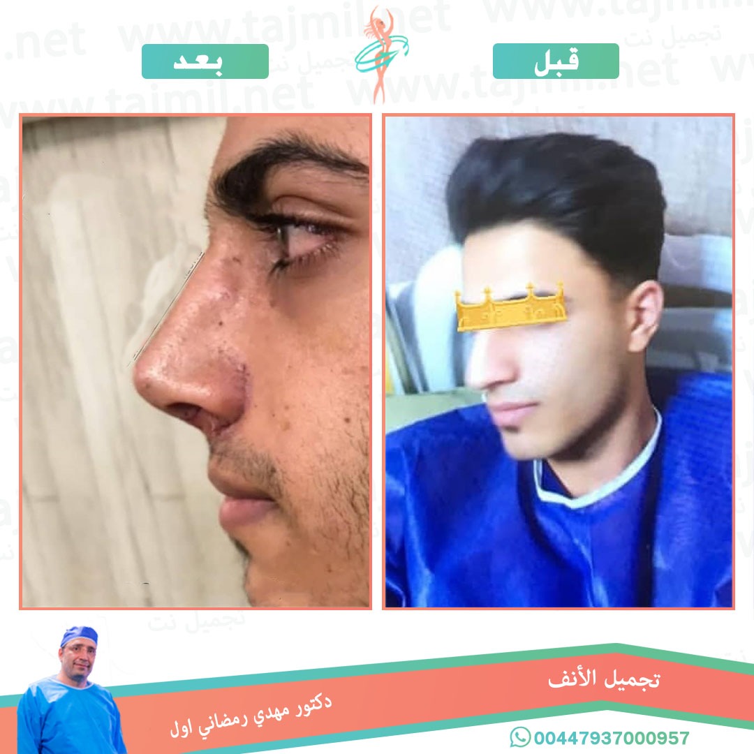  - دكتور مهدي رمضاني اول عملية تجميل الانف في ايران مع تجميل نت