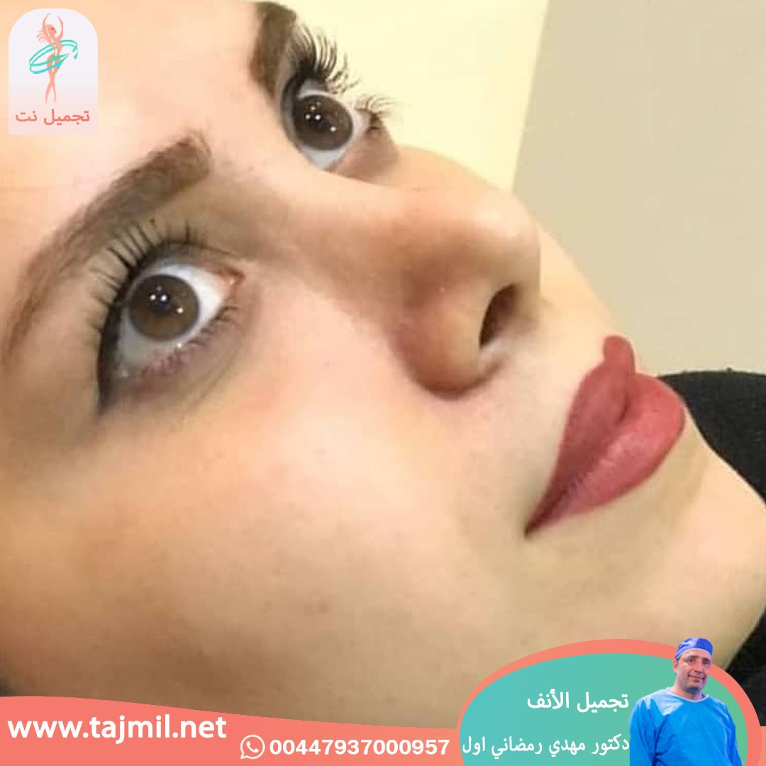  - دكتور مهدي رمضاني اول عملية تجميل الانف في ايران مع تجميل نت