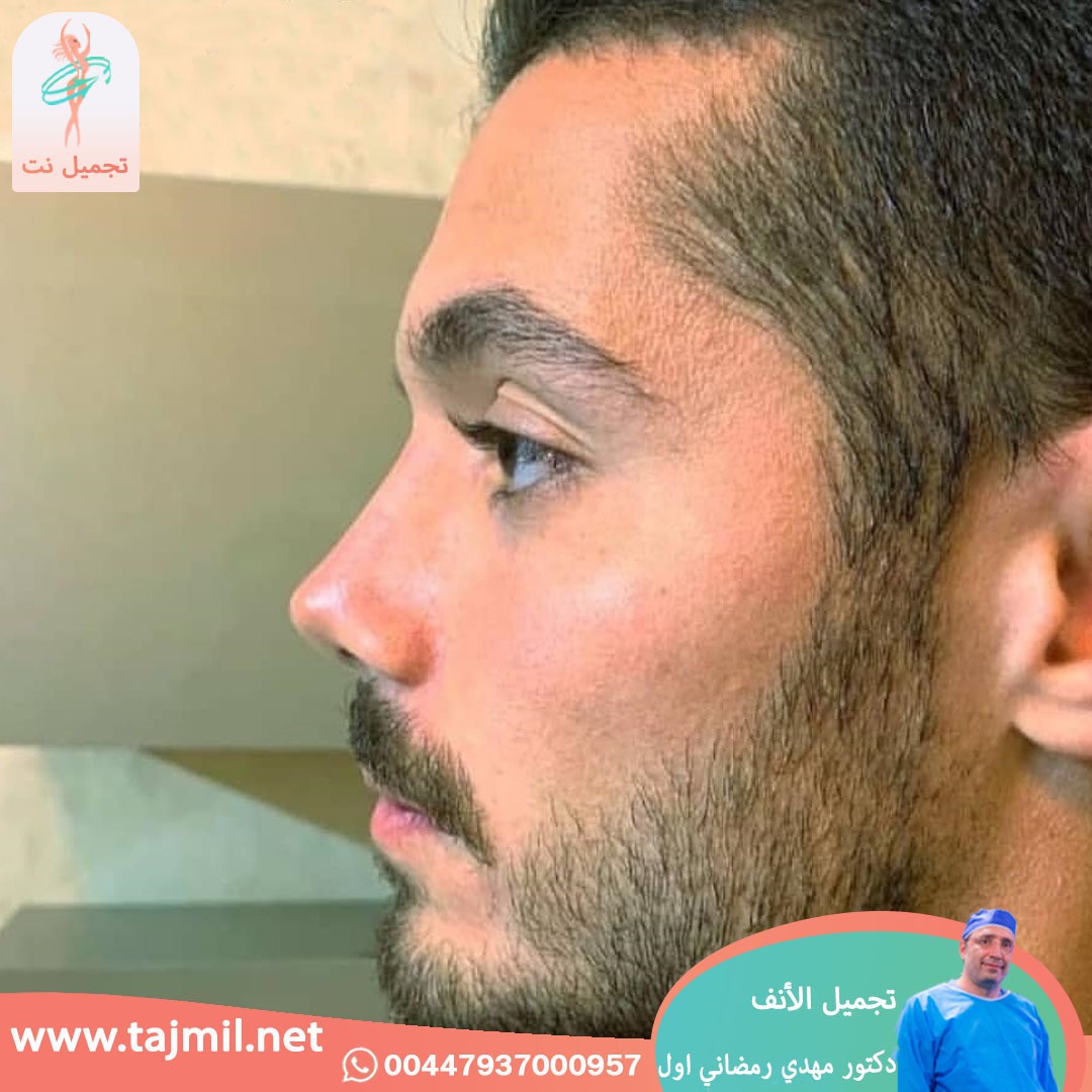  - دكتور مهدي رمضاني اول عملية تجميل الانف في ايران مع تجميل نت