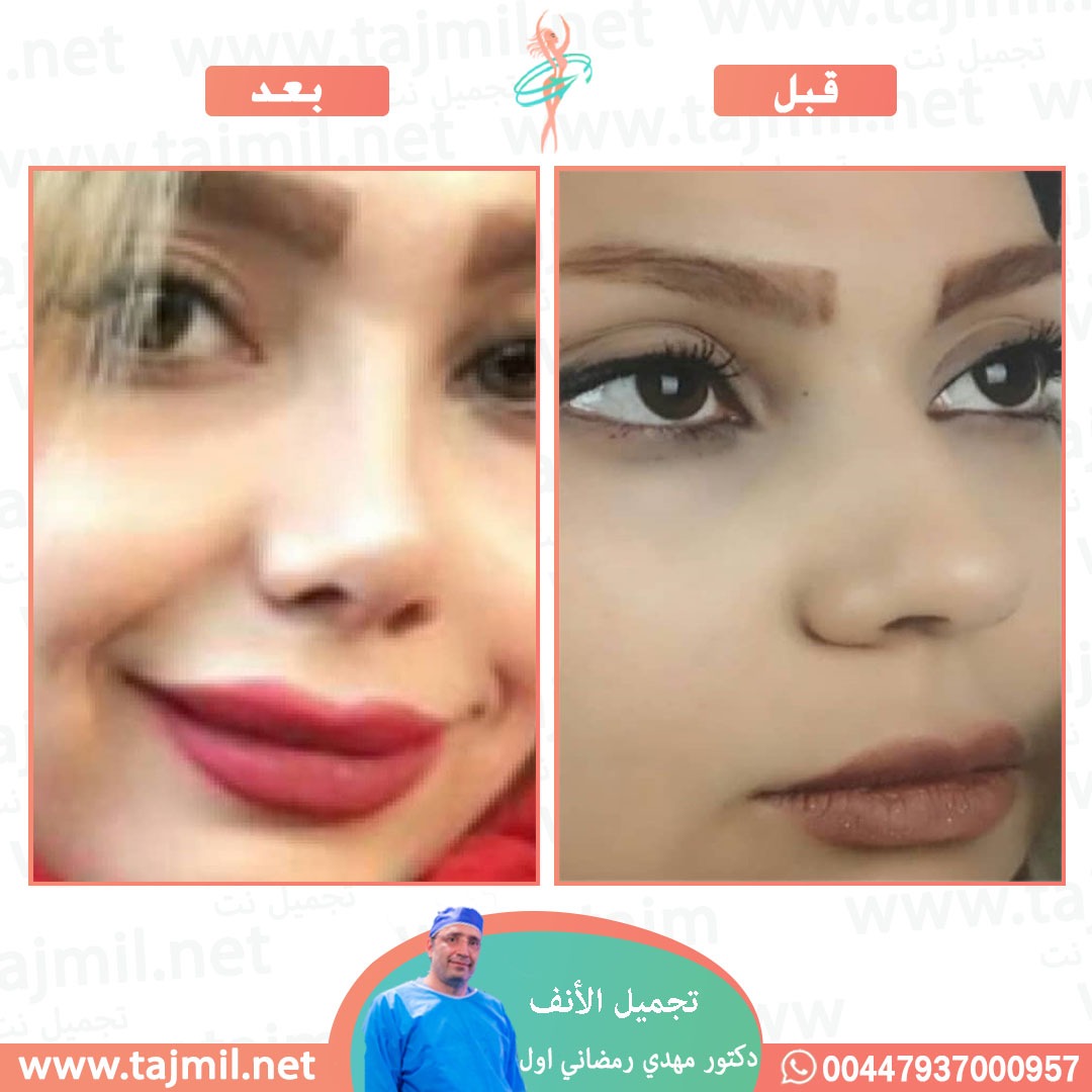  - دكتور مهدي رمضاني اول عملية تجميل الانف في ايران مع تجميل نت