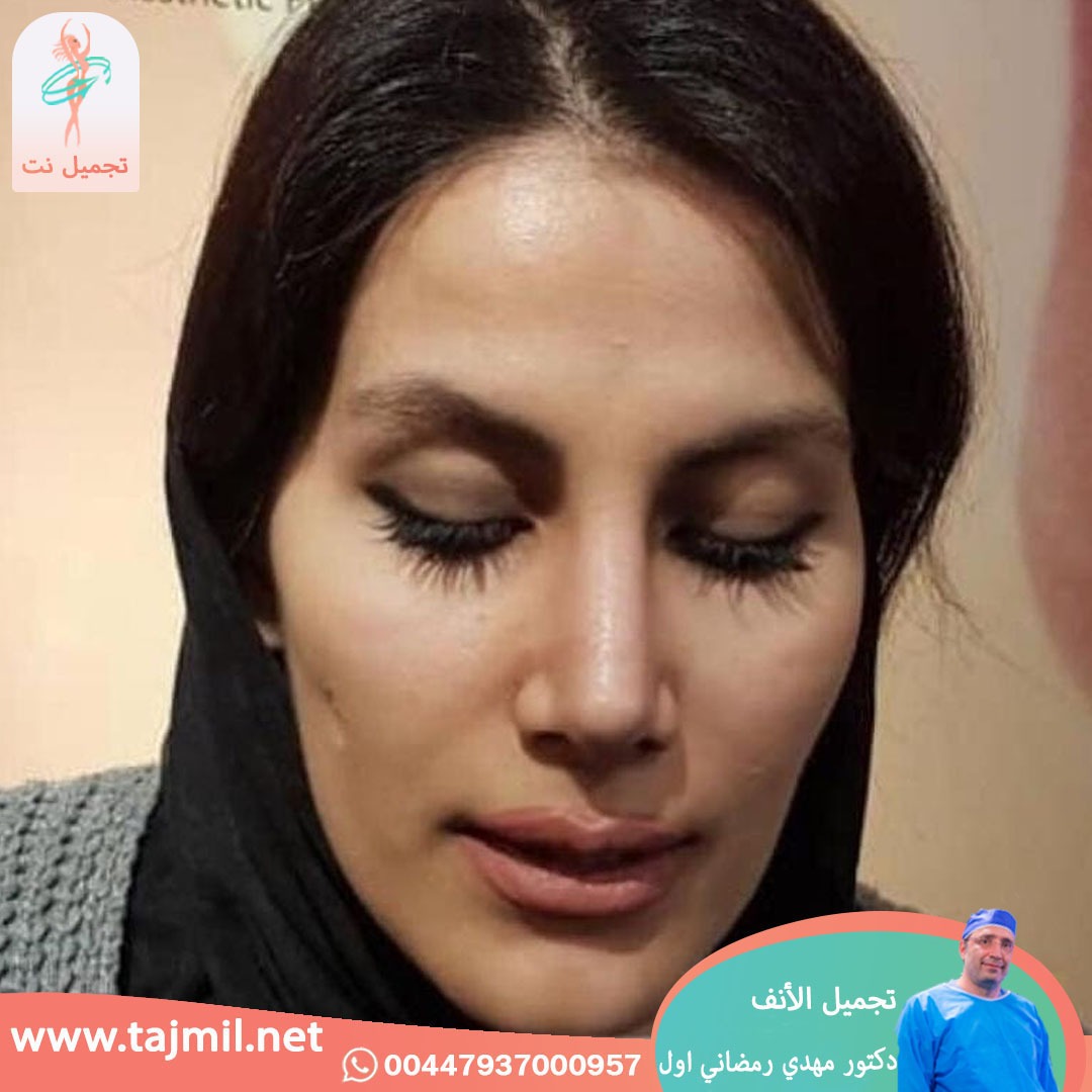  - دكتور مهدي رمضاني اول عملية تجميل الانف في ايران مع تجميل نت