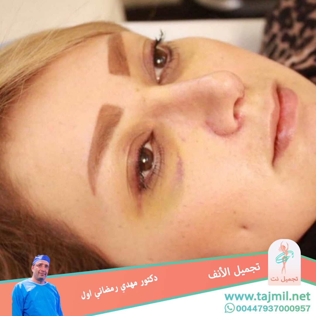  - دكتور مهدي رمضاني اول عملية تجميل الانف في ايران مع تجميل نت